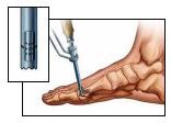 Passo 7: inserção do parafuso Biotrak As marcações a laser na janela de visualização e a extremidade proximal da cânula indicam a profundidade (mm) do parafuso abaixo da superfície do osso.