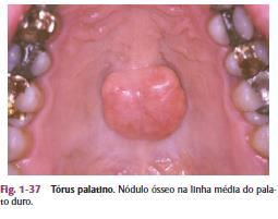 Tórus Plano: Base ampla, Superfície lisa; Geralmente convexa; Dois lados da