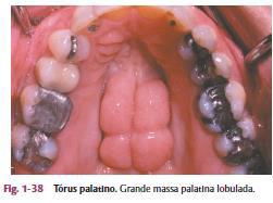 Tórus Lobular: Base lobulada, porém única, podendo ser séssil ou pedunculado. (Fonte: Neville, 2016) o Tratamento: Exame clínico.