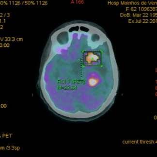 Melanoma