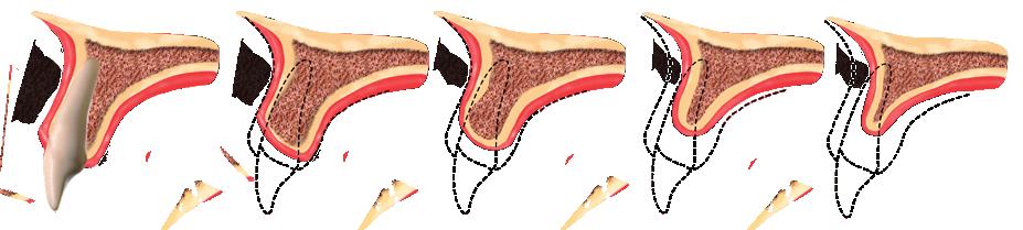 PERDI UM DENTE, E AGORA?