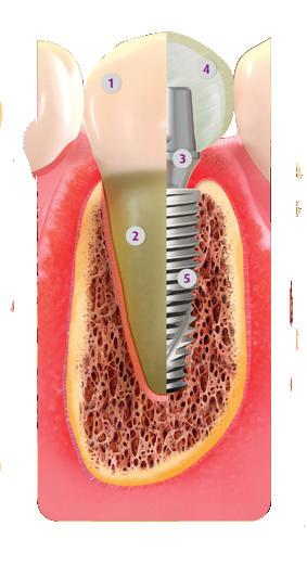 Veja ao lado a comparação da estrutura de um dente natural com uma prótese sobre implante.