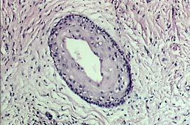 Entretanto, a análise microscópica revelou cavidade cística com limitante epitelial escamoso estratificado e junção epitélio-conjuntiva plana.
