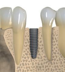 Uso recomendado de implantes BLT NC/RC para os casos de Tabela com as espessuras ósseas mínimas para planejar qual implante BLT (NC/RC) será utilizado.