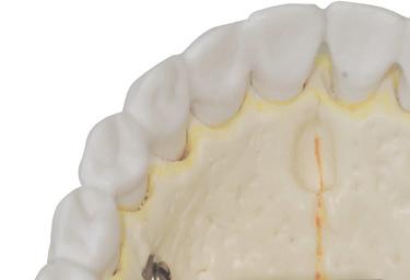 B INCISÃO 16 15 14 24 25 26 Uma incisão e cruz ou em L, entre prémolares e primeiro molar superior,