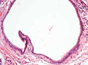 A mucosa bucal (MB) sobrejacente acha-se preservada em sua