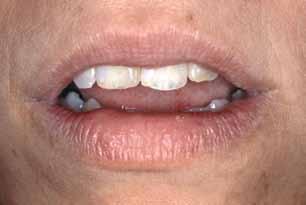 Figura 3 - Mucocele no ventre lingual, segunda localização mais comum nos 987 casos.