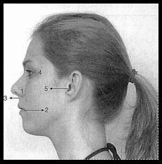 1- Asa do nariz; 2- Comissura labial; 3- Acântio; 4- Borda lateral da orbita. Fig.