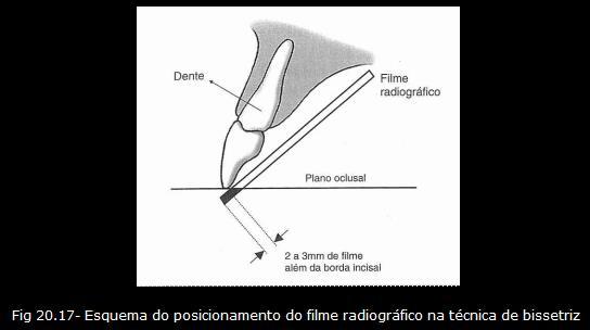 19 Ângulos vertical na Técnica da Bissetriz. Obs: Esses ângulos verticais na verdade são aproximados, devendo ser usados como referência.