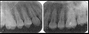 incisivos superiores Fig. 20.