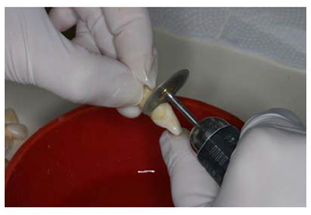 As raízes foram tratadas endodonticamente de acordo com sistema Easy SI (Easy Equipamento Odontológicos, Jardinópolis, Belo Horizonte MG).