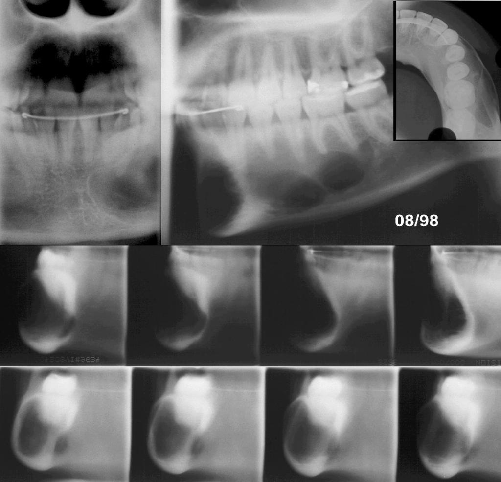 9 Figura 2. Técnica de subtração radiográfica das imagens 1D e 1H, evidenciando pelas áreas escuras que houve aumento no tamanho da lesão.