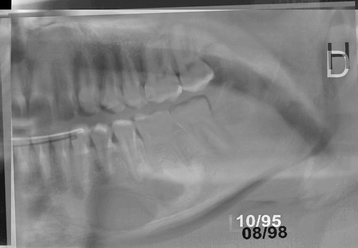 8 Figura 1. Radiografias panorâmicas seqüenciais. A: imagem inicial apresentando área de radiolucidez discreta e limites pouco definidos na região dos dentes 33 e 36.