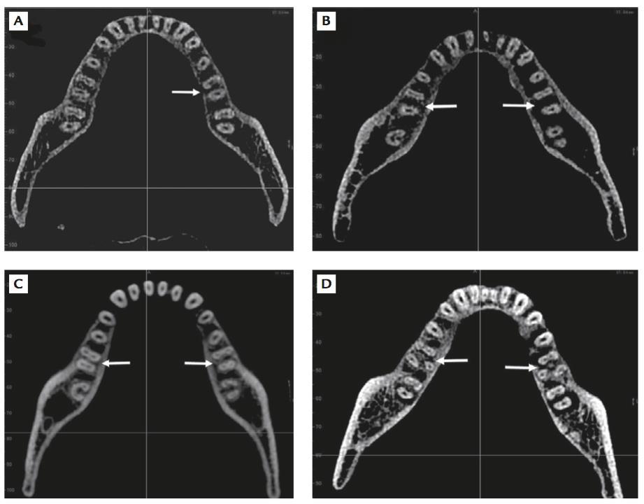 25 Figura 2.1 - Imagens de cortes axiais de primeiros molares inferiores demonstrando: A. 1ºMI com duas raízes e dois canais (seta); B. 1ºMI com duas raízes e três canais bilateralmente (setas); C.