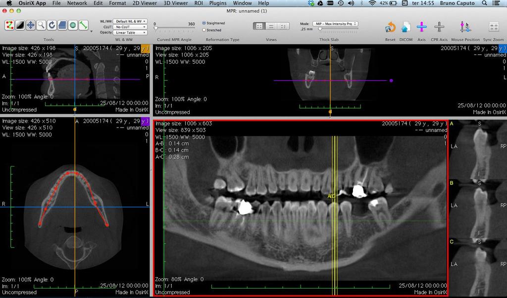 34 Através do software foram avaliados os dentes 1ºPMS, 1ºMS, 1ºPMI, 1ºMI: - Cortes axiais (espessura do corte de 0,3 mm) para análise do números de raízes, canais e forames apicais.