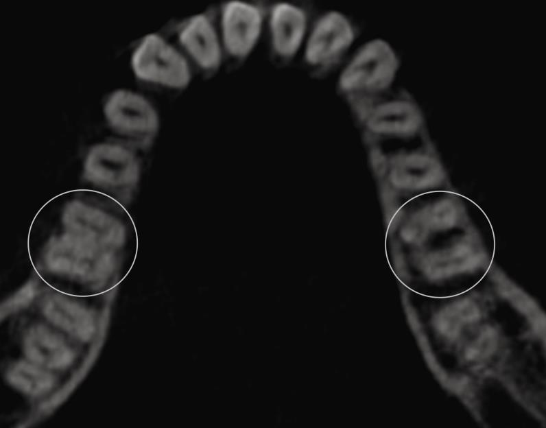 44 Figura 5.1 - Primeiros molares inferiores de paciente do gênero feminino, apresentando 2 canais na raiz distal bilateralmente Variável Tabela 5.