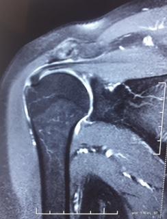 Na figura 2, podemos observar um exame de RM do ombro direito, cujos principais achados radiológicos são: a artrose acromioclavicular; bursite subacromial subdeltoídea; tendinopatia do supraespinhal;