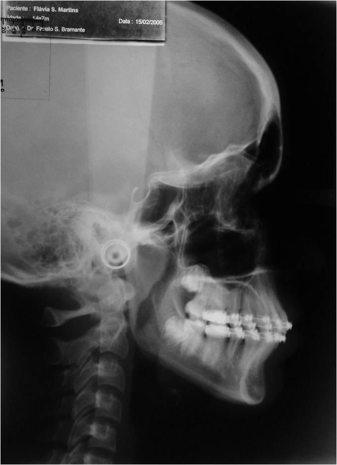 Diversos dispositivos em Ortodontia são conhecidos para esse objetivo, sendo que alguns necessitam da colaboração do paciente.