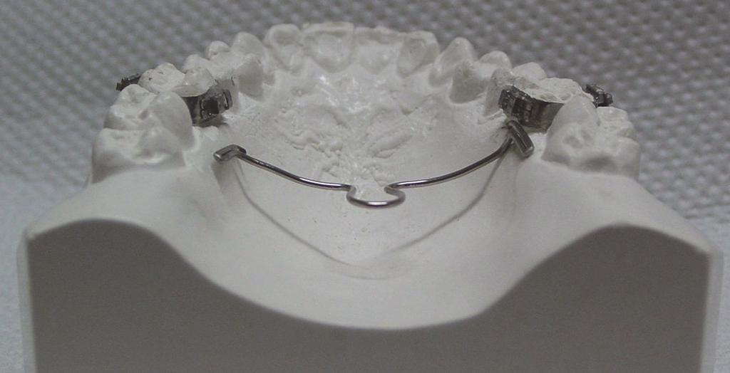 aspecto quantitativo, relacionado com a magnitude de movimento mesial do molar e qualitativo, relacionado com o tipo do movimento do molar.