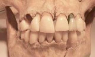 Romano-britânicos tinham menos doenças da gengiva do que os britânicos modernos População de 200-400 DC parece ter tido menos doença periodontal do que hoje As