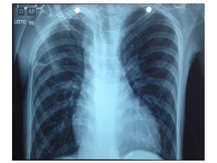 A radiografia de tórax realizada no momento da admissão apresentava alterações como: arco aórtico posicionado a direita e trama vascular diminuída em periferia pulmonar (figura 2).