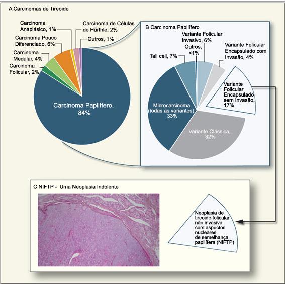 Introdução 9 Adaptado de Fagin JA, 2016 (16) Figura 1. Espectro Patológico do Câncer de Tireoide. Painel A: Incidência relativa dos principais tipos de câncer de tireoide nos Estados Unidos.