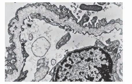 - Acometimento renal: a principal manifestação é a hematúria microscópica persistente, sendo que episódios de hematúria macroscópica esporádicos podem ocorrer ao longo da vida.