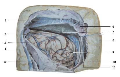 Representação artística do acesso supratentorial-infraoccipital realizado em peça anatômica, do lado esquerdo.