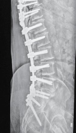 310 heads of the iliac crews, depending on their alignment in relation to the pedicle screws. Generally, the use of the lateral connector was necessary. The diameter of the iliac screws was 6.0 to 7.