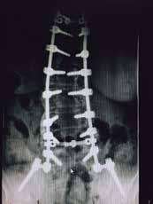 EVALUATION OF THE RESULTS OF PELVIC FIXATION IN LONG LUMBOSACRAL INSTRUMENTATIONS IN ELDERLY PATIENTS 311 Figure 6.