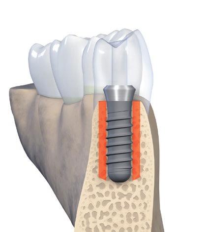Avaliando visualmente o espaço orofacial disponível para um implante Ficando atento à presença de concavidades (retenções linguais e/ou vestibulares) A parede óssea vestíbulo-lingual ou