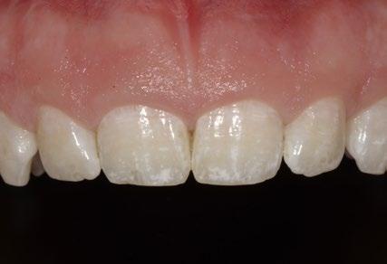 Em comparação com o biotipo gengival fino, as características do biotipo gengival espesso são: Tecidos mais espessos A sonda periodontal não fica visível Faixa maior de