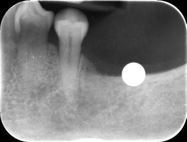 2. Exame As radiografias panorâmicas fornecem uma visão geral do seguinte: Anomalias anatômicas ou lesões patológicas Condição geral dos dentes e do osso de apoio Altura óssea disponível Localização