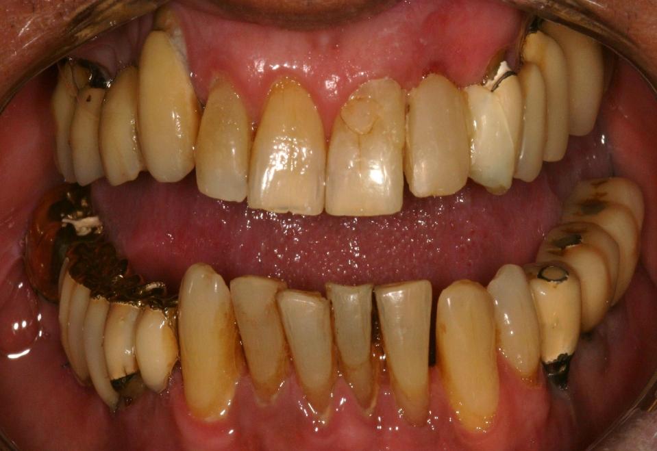 entretanto hoje em dia acredita-se que os dentes se movem igualmente em adultos e crianças, não havendo evidências que se movam mais lentamente nos adultos o que fortalece a opção de uma abordagem