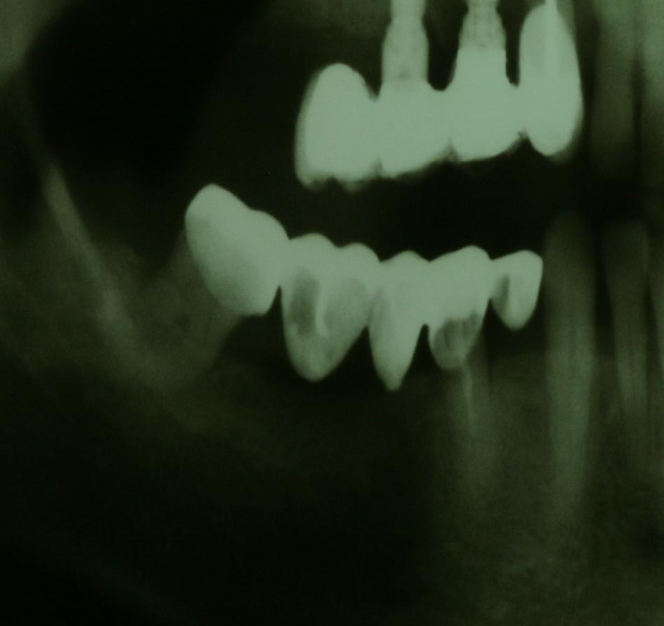 Em régio inferior posterior esquerda o paciente apresentava 3 implantes e prótese sobre implante de 3 elementos mau adaptada Figura 7. Figura 4b.