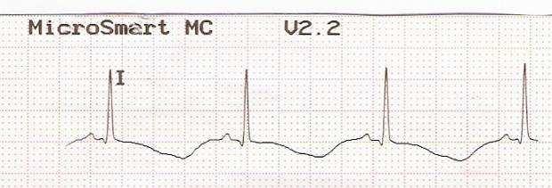 QT RR QT 640 ms QTc = QT RR