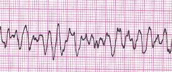 Fibrilação ventricular e TV sem pulso ABC Desfibrilação (1x) 2 J/Kg Epinefrina (1 x) EV/IO: 0,01mg/Kg (0,1ml/Kg - 1:10.