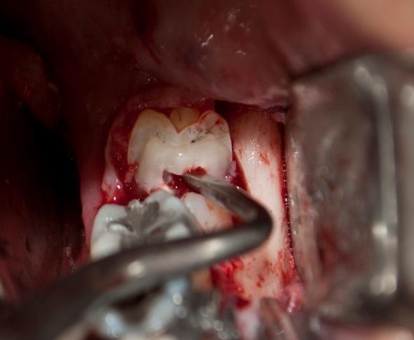 O tratamento proposto foi a remoção cirúrgica dos quartos molares inferiores simultaneamente à exodontia dos dentes terceiros molares (38 e 48) e, em um segundo momento, a exodontia do 18 e 28 e dos