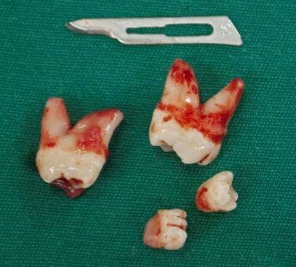 remoção. Após a exodontia dos terceiros molares, foi realizada osteotomia na região posterior e assim, tornou-se visível os supranumerários adjacentes, e sua exérese foi realizada (Figura 6).