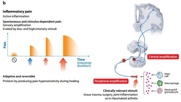 Dor Inflamatória Inflamação ativa; Dor espontânea e estímulo-dependente; Amplificação sensorial Evocada por estímulo de baixa e alta intensidade (nocivo) Adaptativa e reversível; protege