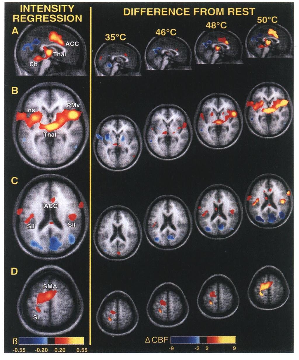 Variações no fluxo sanguíneo cerebral (CBF) em cérebro humano pelo progressivo aumento da temperatura.