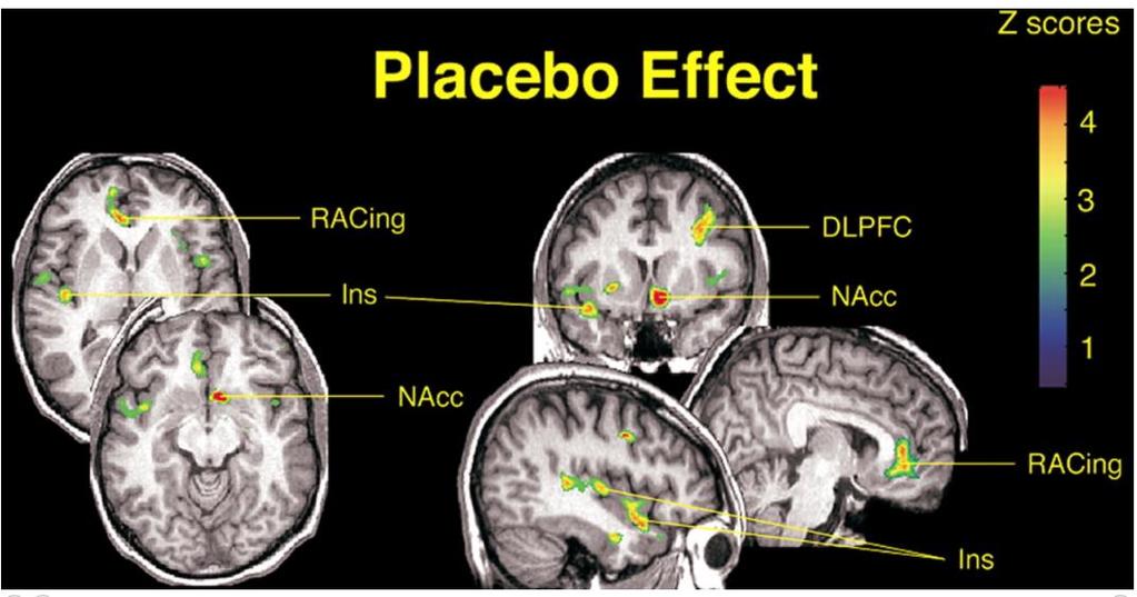 Effects of placebo on the activation of μ-opioid receptor-mediated