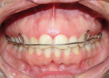Componente dentoalveolar inferior II.NB (º) 35.4 44.0 II - NB (mm) 10.0 10.5 Relação Dentária Relação Molar (mm) 0.1-0.
