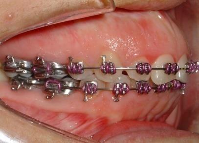 Subdivisão, dentre elas: 1 Tratamento orto-cirúrgico; 2 Tratamento com aparelhos funcionais; 3 - Tratamento com compensação dentoalveolar.