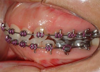 bandagem dos molares. Montagem do aparelho para realização da compensação dentária utilizou-se braquetes pré-ajustados, slot.022 x.