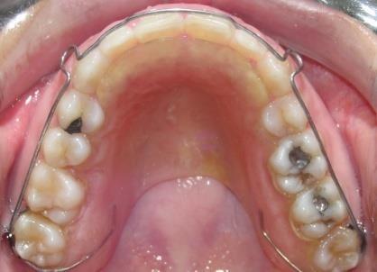 Na radiografia panorâmica final verificou-se melhora no