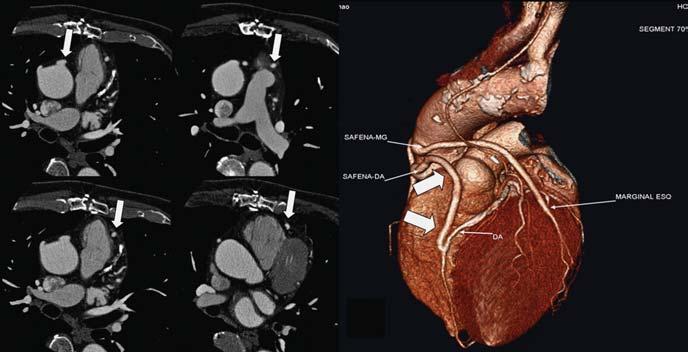 imagens de reconstruções e estudos de angio-tc de coronárias.