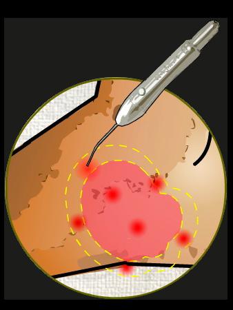 Queimaduras DE: 4 a 40 J/cm2 Dose (energia): 1 J P: 100 mw Comprimento de onda: 630 a 690 nm (Vermelho) Aplicar pontos ao redor da úlcera, sobre o tecido íntegro, distante à 1 cm da borda.