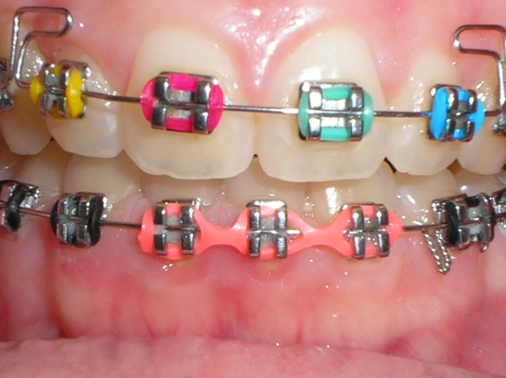 18 1 INTRODUÇÃO Ortodontia é a especialidade da Odontologia que trata das deformidades dentofaciais (LINO, 1993).