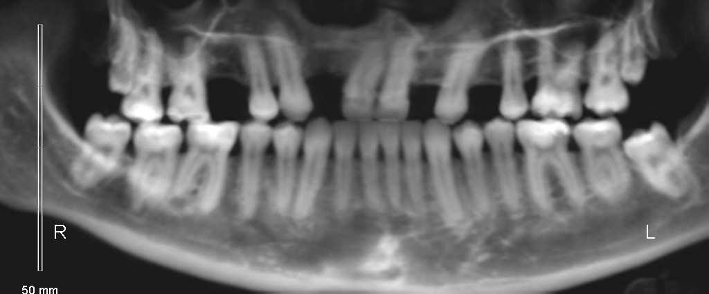 Este último apresentou perda óssea distalmente à raiz do dente 21, com fechamento do espaço deixado pela ausência do incisivo lateral pela movimentação mesial do canino adjacente, enquanto que os